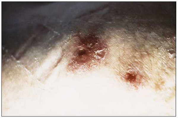 Figure 1 - Abscesses due to Mycobacterium abscessus Linked to Injection ...