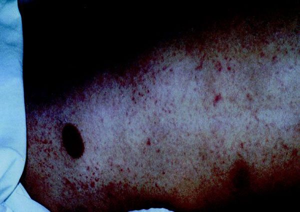 Diffuse petechial rash of epidemic typhus (day 7).