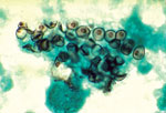 Thumbnail of Cysts of Pneumocystis jirovecii in smear from bronchoalveolar lavage. Methenamine silver stain. CDC/Dr. Russell K. Brynes