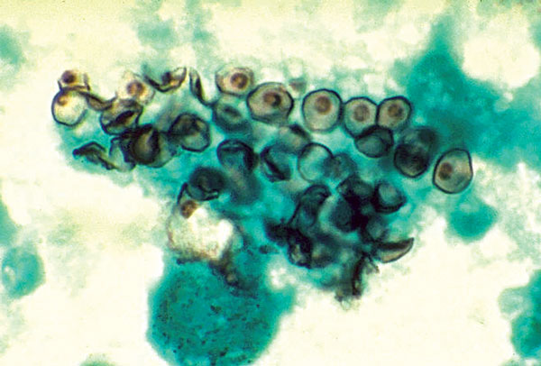 Cysts of Pneumocystis jirovecii in smear from bronchoalveolar lavage. Methenamine silver stain. CDC/Dr. Russell K. Brynes