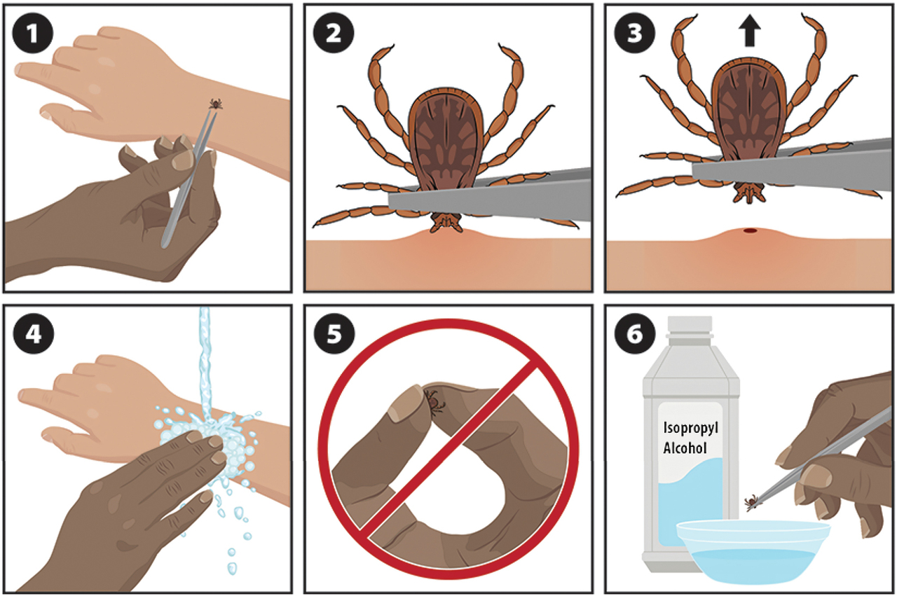 Figure 4-01 How to remove a tick: instructions for travelers