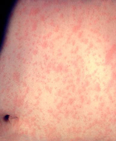 measles rash